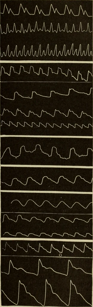 An illustration from The diagnostics of internal medicine : a clinical treatise upon the recognised principles of medical diagnosis, prepared for the use of students and practitioners of medicine / by Glentworth Reeve Butler ... ; with five coloured plates and two hundred and seventy-two illustrations and charts in the text., 1909, leaf 447
