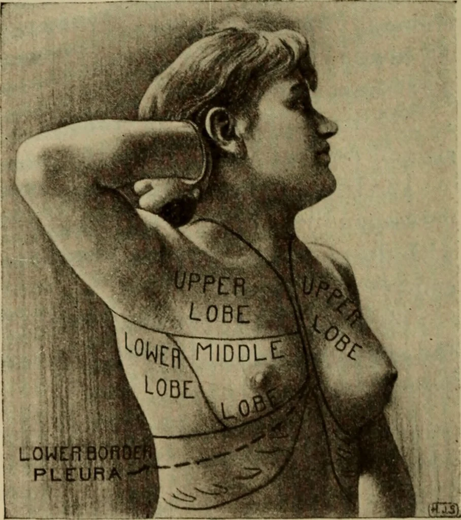 An illustration from The diagnostics of internal medicine : a clinical treatise upon the recognised principles of medical diagnosis, prepared for the use of students and practitioners of medicine / by Glentworth Reeve Butler ... ; with five coloured plates and two hundred and seventy-two illustrations and charts in the text., 1909, leaf 454