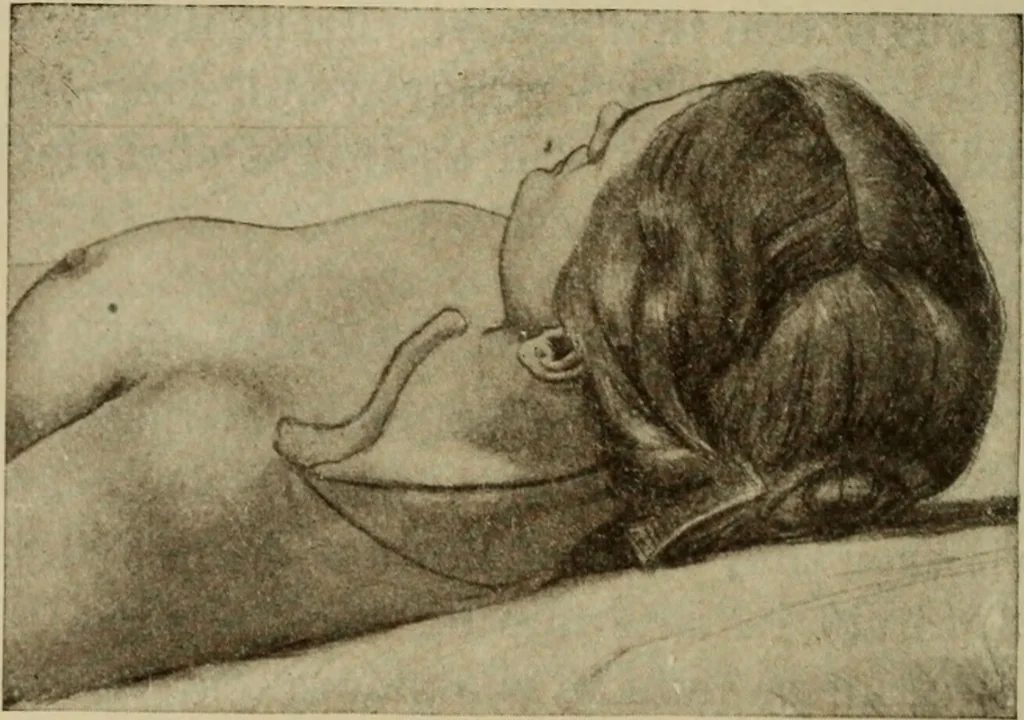 An illustration from The diagnostics of internal medicine : a clinical treatise upon the recognised principles of medical diagnosis, prepared for the use of students and practitioners of medicine / by Glentworth Reeve Butler ... ; with five coloured plates and two hundred and seventy-two illustrations and charts in the text., 1909, leaf 470