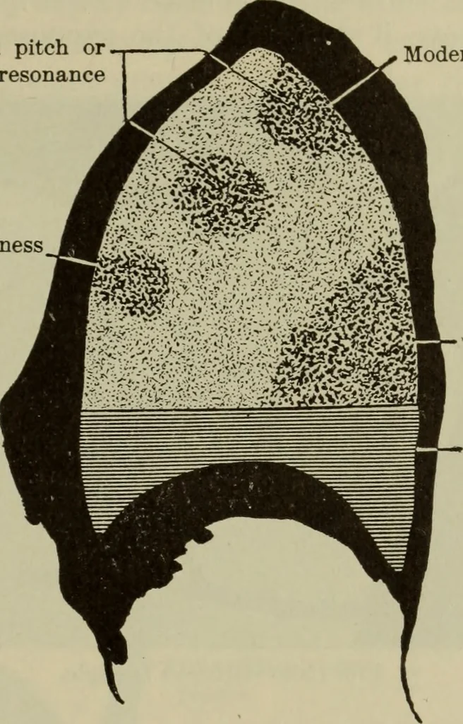 An illustration from The diagnostics of internal medicine : a clinical treatise upon the recognised principles of medical diagnosis, prepared for the use of students and practitioners of medicine / by Glentworth Reeve Butler ... ; with five coloured plates and two hundred and seventy-two illustrations and charts in the text., 1909, leaf 475