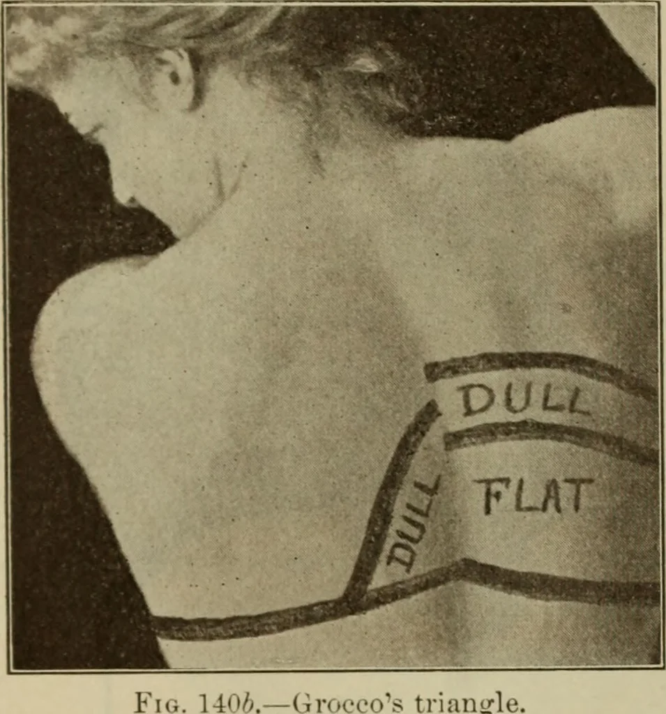 An illustration from The diagnostics of internal medicine : a clinical treatise upon the recognised principles of medical diagnosis, prepared for the use of students and practitioners of medicine / by Glentworth Reeve Butler ... ; with five coloured plates and two hundred and seventy-two illustrations and charts in the text., 1909, leaf 476
