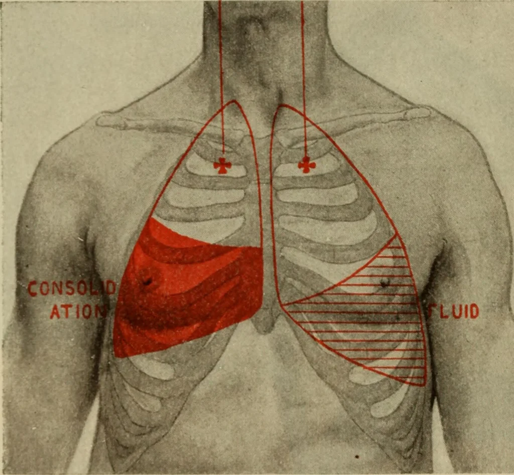 An illustration from The diagnostics of internal medicine : a clinical treatise upon the recognised principles of medical diagnosis, prepared for the use of students and practitioners of medicine / by Glentworth Reeve Butler ... ; with five coloured plates and two hundred and seventy-two illustrations and charts in the text., 1909, leaf 478