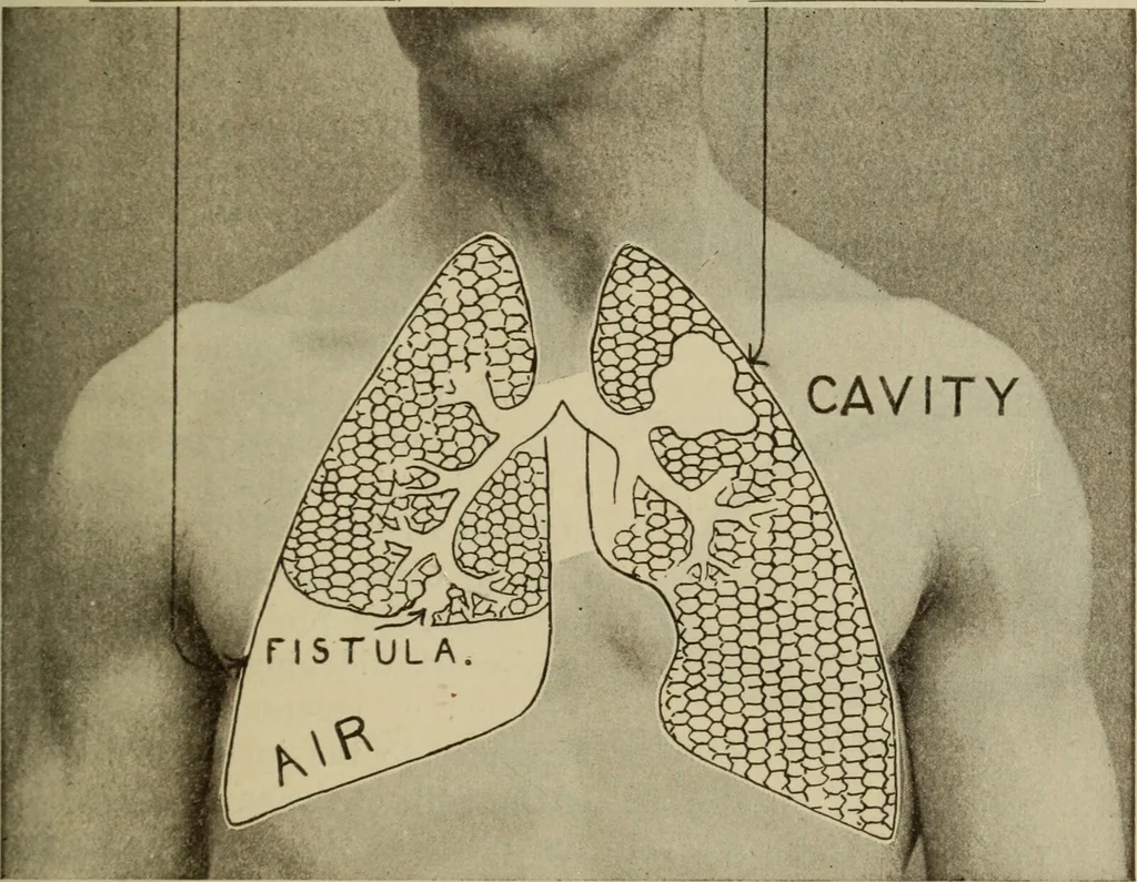 An illustration from The diagnostics of internal medicine : a clinical treatise upon the recognised principles of medical diagnosis, prepared for the use of students and practitioners of medicine / by Glentworth Reeve Butler ... ; with five coloured plates and two hundred and seventy-two illustrations and charts in the text., 1909, leaf 481