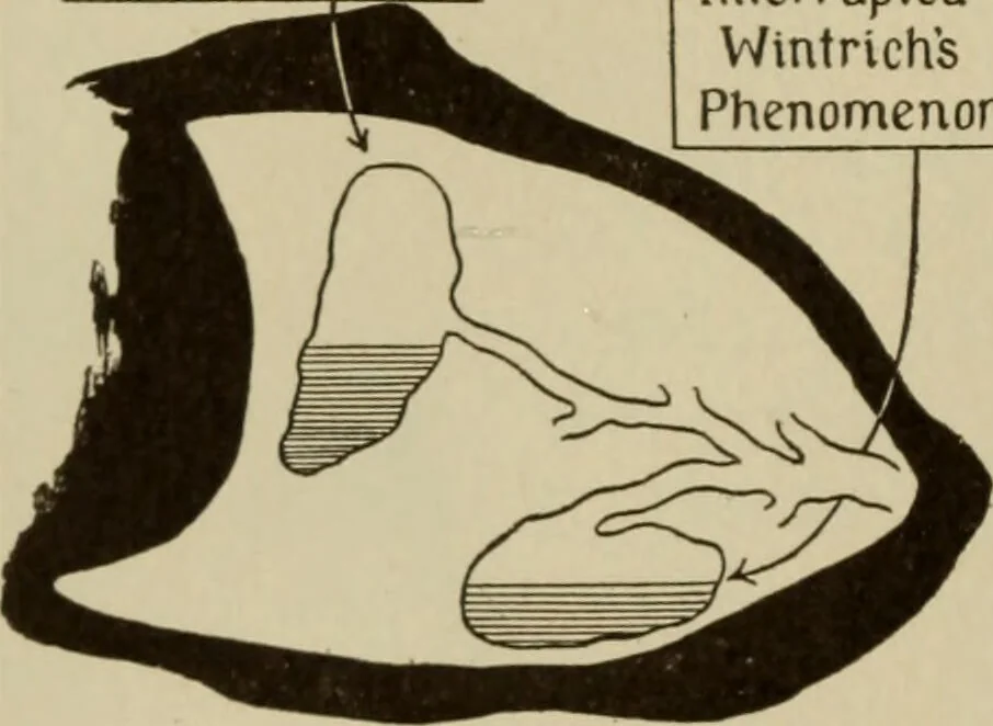 An illustration from The diagnostics of internal medicine : a clinical treatise upon the recognised principles of medical diagnosis, prepared for the use of students and practitioners of medicine / by Glentworth Reeve Butler ... ; with five coloured plates and two hundred and seventy-two illustrations and charts in the text., 1909, leaf 482