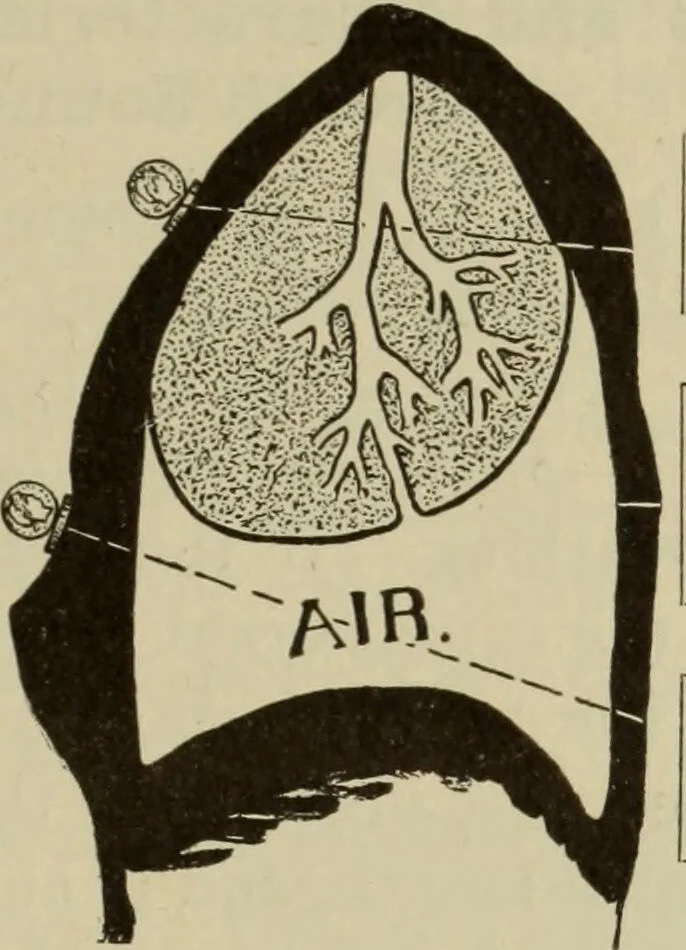 An illustration from The diagnostics of internal medicine : a clinical treatise upon the recognised principles of medical diagnosis, prepared for the use of students and practitioners of medicine / by Glentworth Reeve Butler ... ; with five coloured plates and two hundred and seventy-two illustrations and charts in the text., 1909, leaf 483