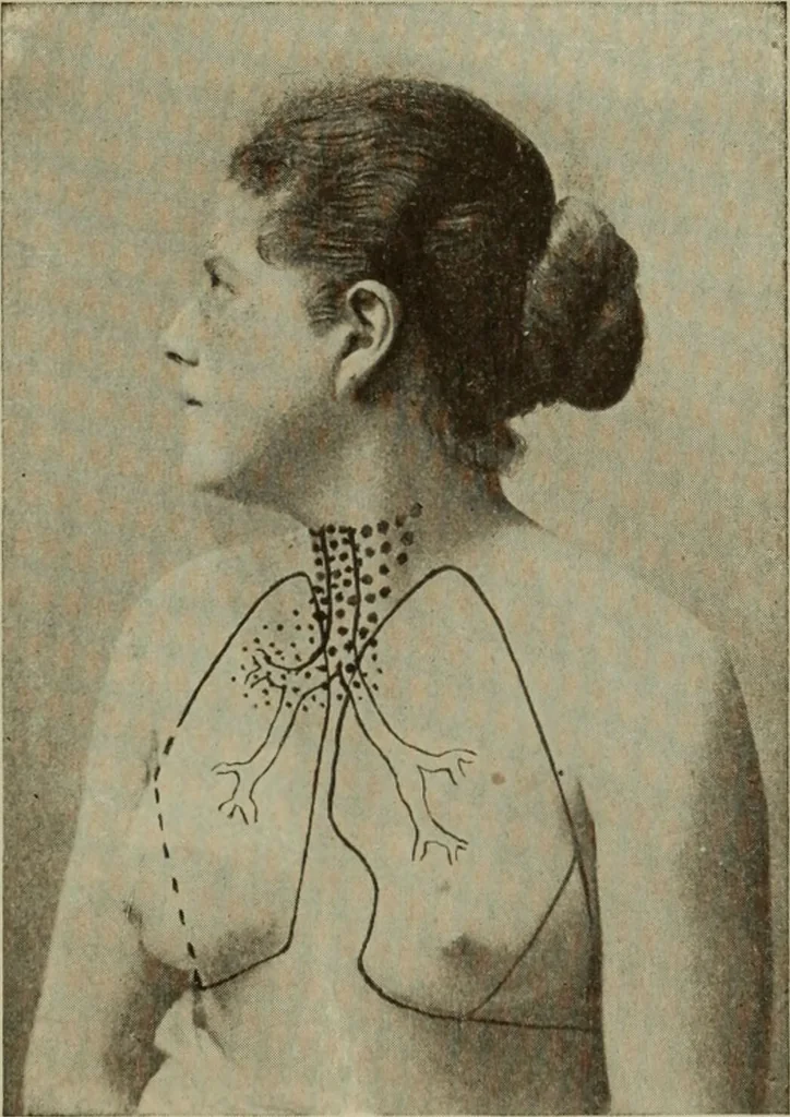 An illustration from The diagnostics of internal medicine : a clinical treatise upon the recognised principles of medical diagnosis, prepared for the use of students and practitioners of medicine / by Glentworth Reeve Butler ... ; with five coloured plates and two hundred and seventy-two illustrations and charts in the text., 1909, leaf 485