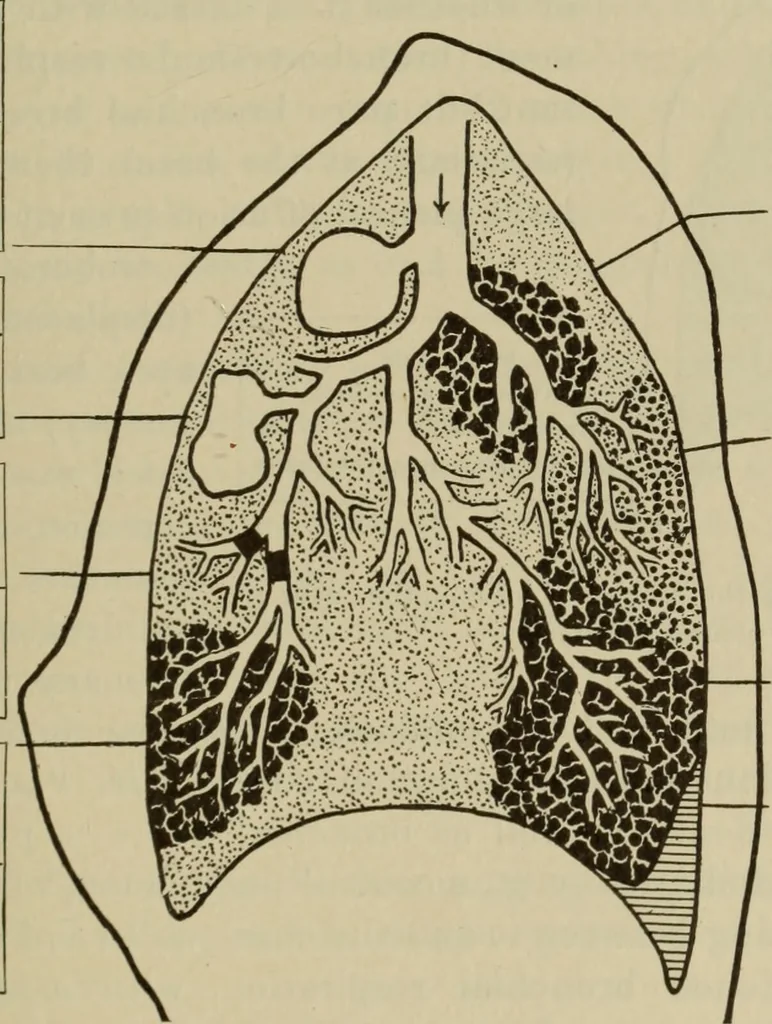 An illustration from The diagnostics of internal medicine : a clinical treatise upon the recognised principles of medical diagnosis, prepared for the use of students and practitioners of medicine / by Glentworth Reeve Butler ... ; with five coloured plates and two hundred and seventy-two illustrations and charts in the text., 1909, leaf 487