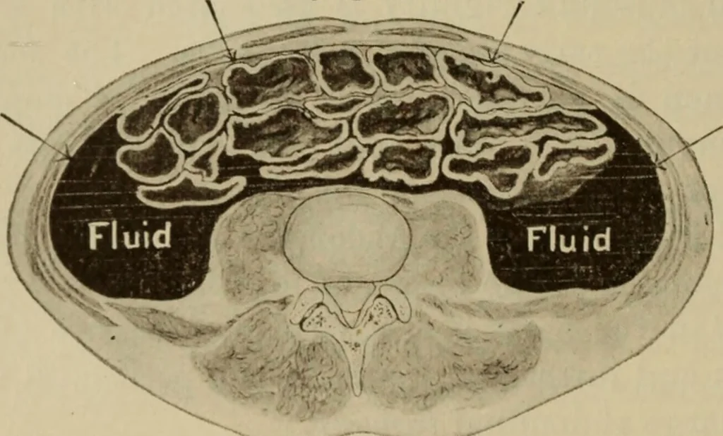 An illustration from The diagnostics of internal medicine : a clinical treatise upon the recognised principles of medical diagnosis, prepared for the use of students and practitioners of medicine / by Glentworth Reeve Butler ... ; with five coloured plates and two hundred and seventy-two illustrations and charts in the text., 1909, leaf 508