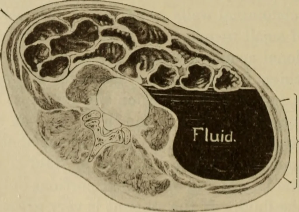 An illustration from The diagnostics of internal medicine : a clinical treatise upon the recognised principles of medical diagnosis, prepared for the use of students and practitioners of medicine / by Glentworth Reeve Butler ... ; with five coloured plates and two hundred and seventy-two illustrations and charts in the text., 1909, leaf 508
