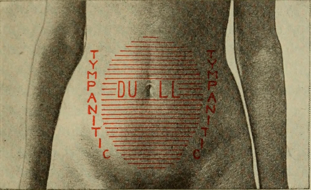 An illustration from The diagnostics of internal medicine : a clinical treatise upon the recognised principles of medical diagnosis, prepared for the use of students and practitioners of medicine / by Glentworth Reeve Butler ... ; with five coloured plates and two hundred and seventy-two illustrations and charts in the text., 1909, leaf 509
