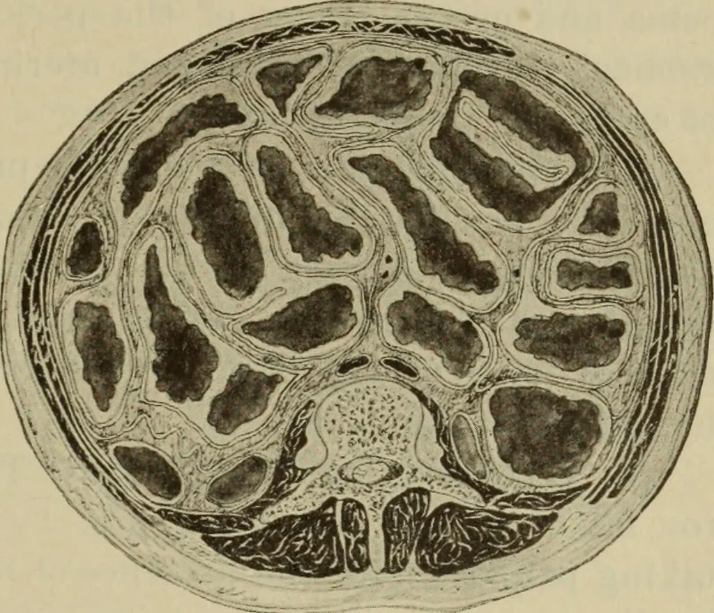 An illustration from The diagnostics of internal medicine : a clinical treatise upon the recognised principles of medical diagnosis, prepared for the use of students and practitioners of medicine / by Glentworth Reeve Butler ... ; with five coloured plates and two hundred and seventy-two illustrations and charts in the text., 1909, leaf 511