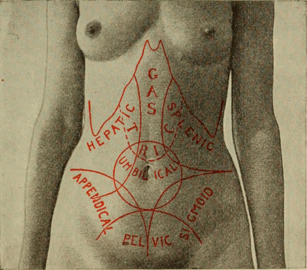 An illustration from The diagnostics of internal medicine : a clinical treatise upon the recognised principles of medical diagnosis, prepared for the use of students and practitioners of medicine / by Glentworth Reeve Butler ... ; with five coloured plates and two hundred and seventy-two illustrations and charts in the text., 1909, leaf 513