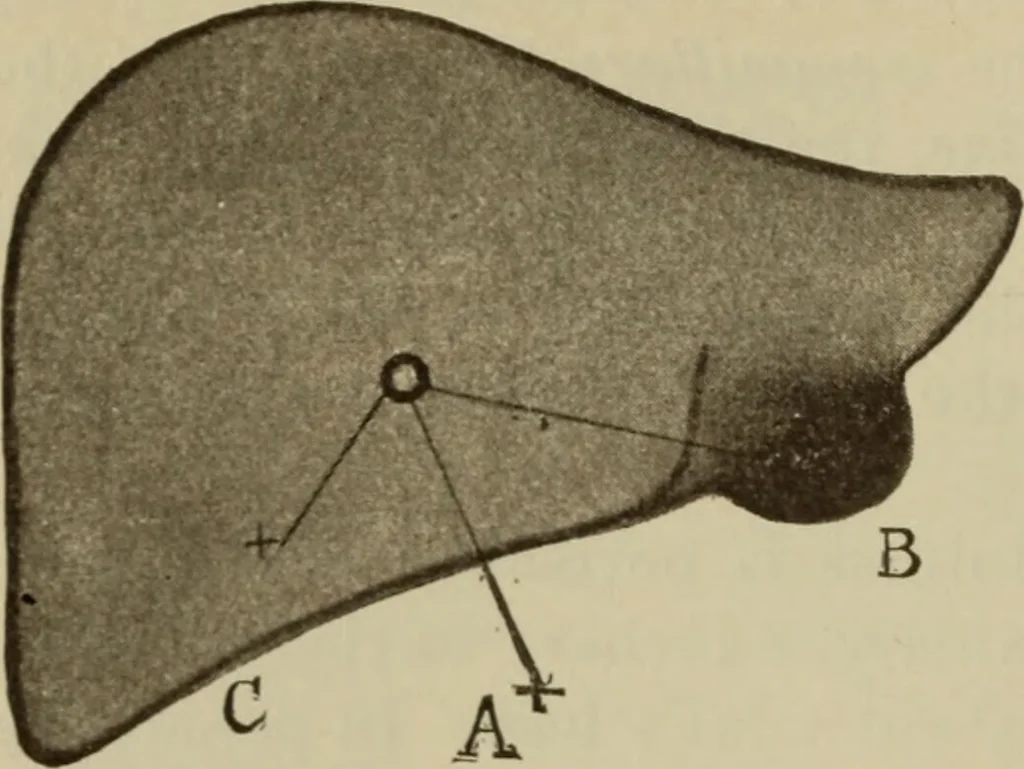 An illustration from The diagnostics of internal medicine : a clinical treatise upon the recognised principles of medical diagnosis, prepared for the use of students and practitioners of medicine / by Glentworth Reeve Butler ... ; with five coloured plates and two hundred and seventy-two illustrations and charts in the text., 1909, leaf 544