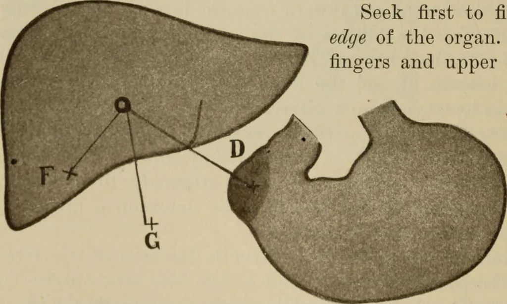 An illustration from The diagnostics of internal medicine : a clinical treatise upon the recognised principles of medical diagnosis, prepared for the use of students and practitioners of medicine / by Glentworth Reeve Butler ... ; with five coloured plates and two hundred and seventy-two illustrations and charts in the text., 1909, leaf 544
