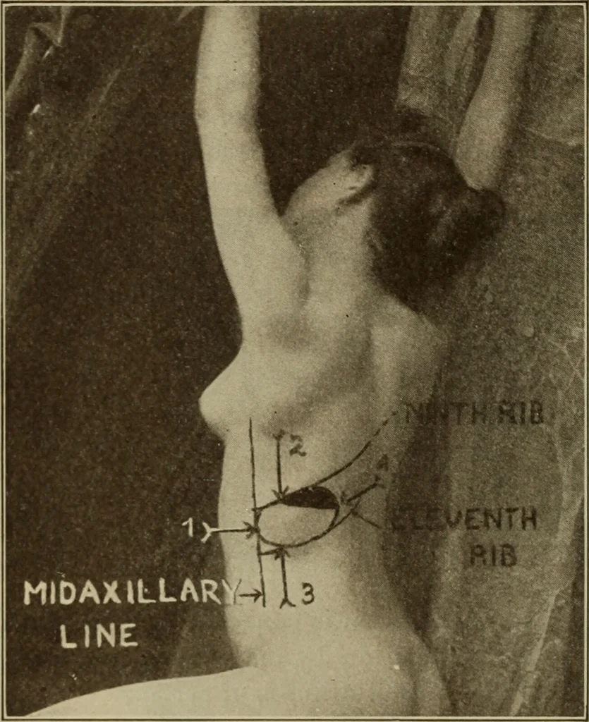 An illustration from The diagnostics of internal medicine : a clinical treatise upon the recognised principles of medical diagnosis, prepared for the use of students and practitioners of medicine / by Glentworth Reeve Butler ... ; with five coloured plates and two hundred and seventy-two illustrations and charts in the text., 1909, leaf 550
