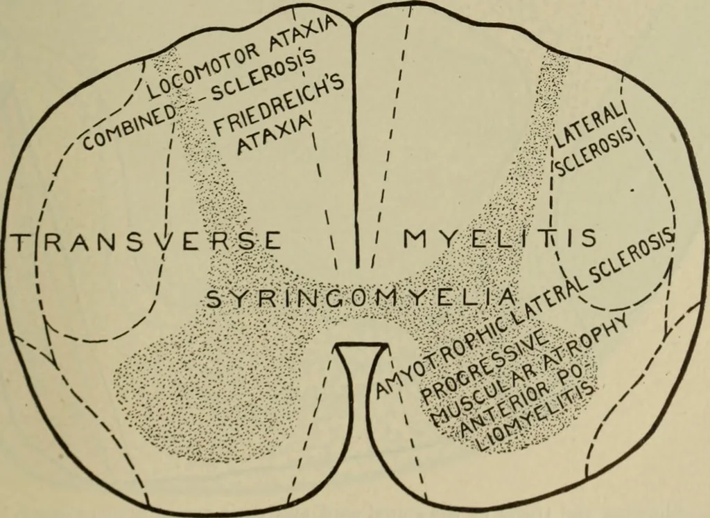 An illustration from The diagnostics of internal medicine : a clinical treatise upon the recognised principles of medical diagnosis, prepared for the use of students and practitioners of medicine / by Glentworth Reeve Butler ... ; with five coloured plates and two hundred and seventy-two illustrations and charts in the text., 1909, leaf 565