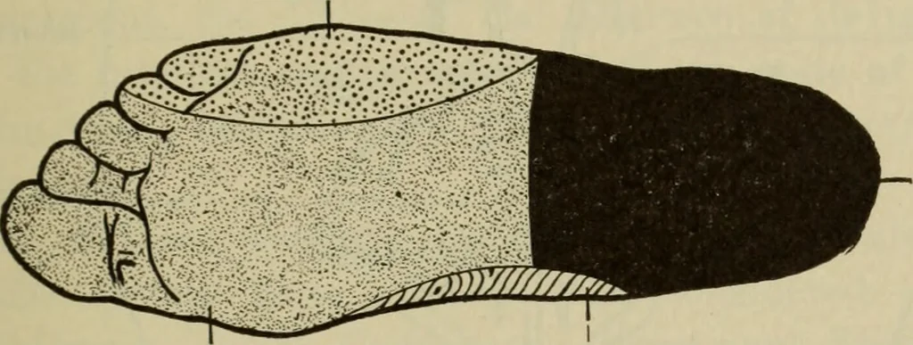 An illustration from The diagnostics of internal medicine : a clinical treatise upon the recognised principles of medical diagnosis, prepared for the use of students and practitioners of medicine / by Glentworth Reeve Butler ... ; with five coloured plates and two hundred and seventy-two illustrations and charts in the text., 1909, leaf 581