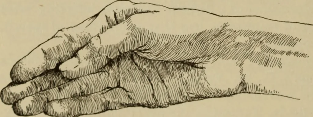 An illustration from The diagnostics of internal medicine : a clinical treatise upon the recognised principles of medical diagnosis, prepared for the use of students and practitioners of medicine / by Glentworth Reeve Butler ... ; with five coloured plates and two hundred and seventy-two illustrations and charts in the text., 1909, leaf 594