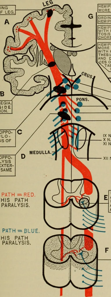 An illustration from The diagnostics of internal medicine : a clinical treatise upon the recognised principles of medical diagnosis, prepared for the use of students and practitioners of medicine / by Glentworth Reeve Butler ... ; with five coloured plates and two hundred and seventy-two illustrations and charts in the text., 1909, leaf 601