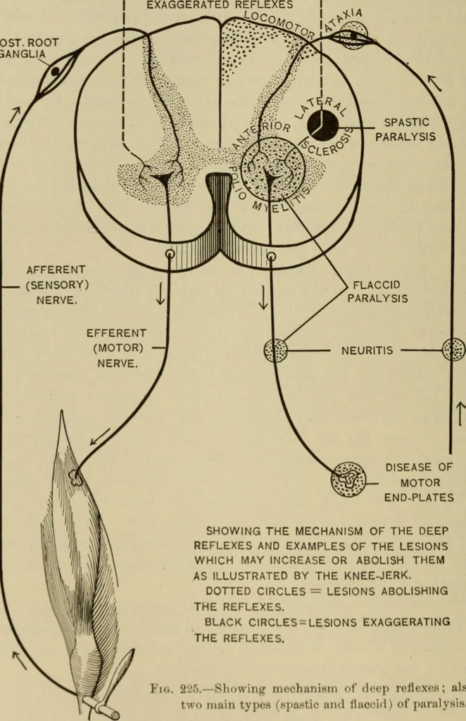An illustration from The diagnostics of internal medicine : a clinical treatise upon the recognised principles of medical diagnosis, prepared for the use of students and practitioners of medicine / by Glentworth Reeve Butler ... ; with five coloured plates and two hundred and seventy-two illustrations and charts in the text., 1909, leaf 618