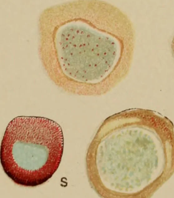 An illustration from The diagnostics of internal medicine : a clinical treatise upon the recognised principles of medical diagnosis, prepared for the use of students and practitioners of medicine / by Glentworth Reeve Butler ... ; with five coloured plates and two hundred and seventy-two illustrations and charts in the text., 1909, leaf 665