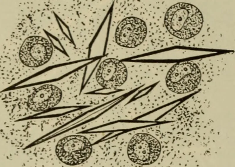 An illustration from The diagnostics of internal medicine : a clinical treatise upon the recognised principles of medical diagnosis, prepared for the use of students and practitioners of medicine / by Glentworth Reeve Butler ... ; with five coloured plates and two hundred and seventy-two illustrations and charts in the text., 1909, leaf 702