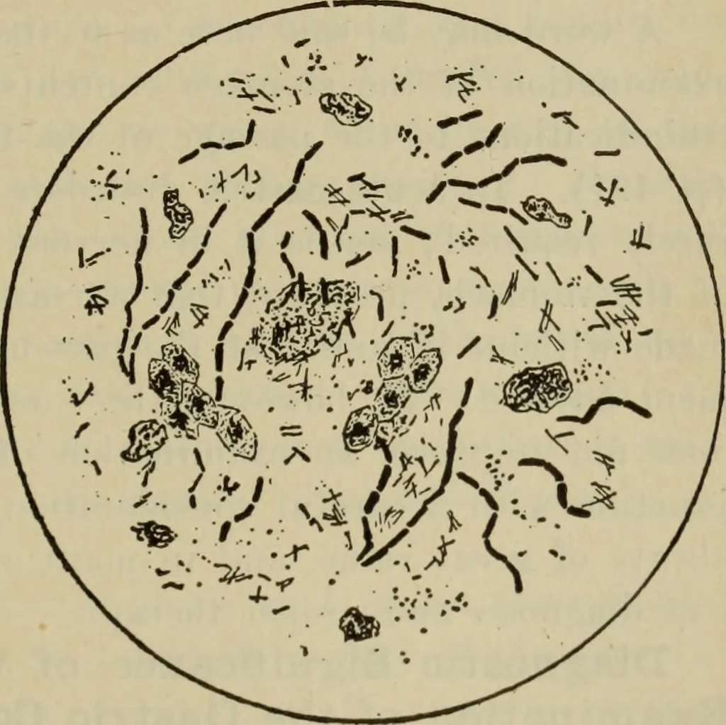 An illustration from The diagnostics of internal medicine : a clinical treatise upon the recognised principles of medical diagnosis, prepared for the use of students and practitioners of medicine / by Glentworth Reeve Butler ... ; with five coloured plates and two hundred and seventy-two illustrations and charts in the text., 1909, leaf 717
