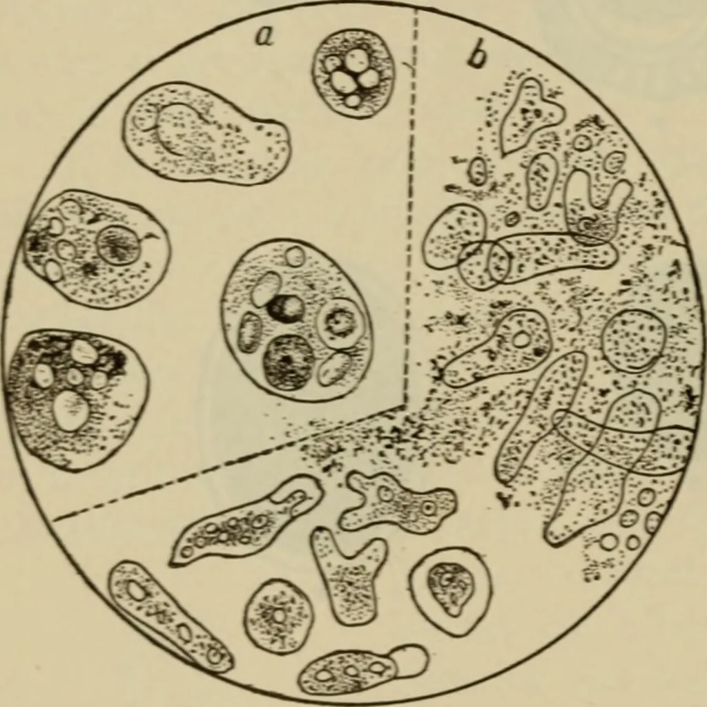 An illustration from The diagnostics of internal medicine : a clinical treatise upon the recognised principles of medical diagnosis, prepared for the use of students and practitioners of medicine / by Glentworth Reeve Butler ... ; with five coloured plates and two hundred and seventy-two illustrations and charts in the text., 1909, leaf 728