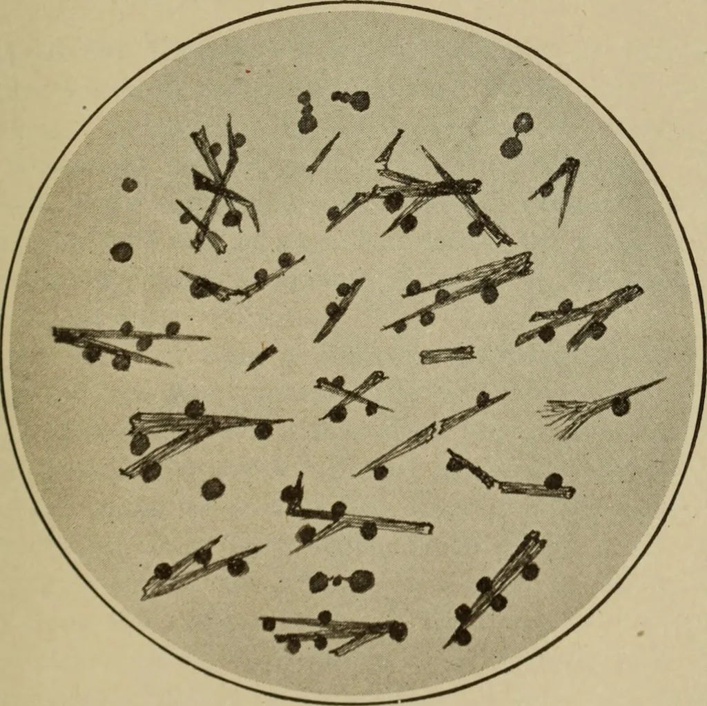 An illustration from The diagnostics of internal medicine : a clinical treatise upon the recognised principles of medical diagnosis, prepared for the use of students and practitioners of medicine / by Glentworth Reeve Butler ... ; with five coloured plates and two hundred and seventy-two illustrations and charts in the text., 1909, leaf 749