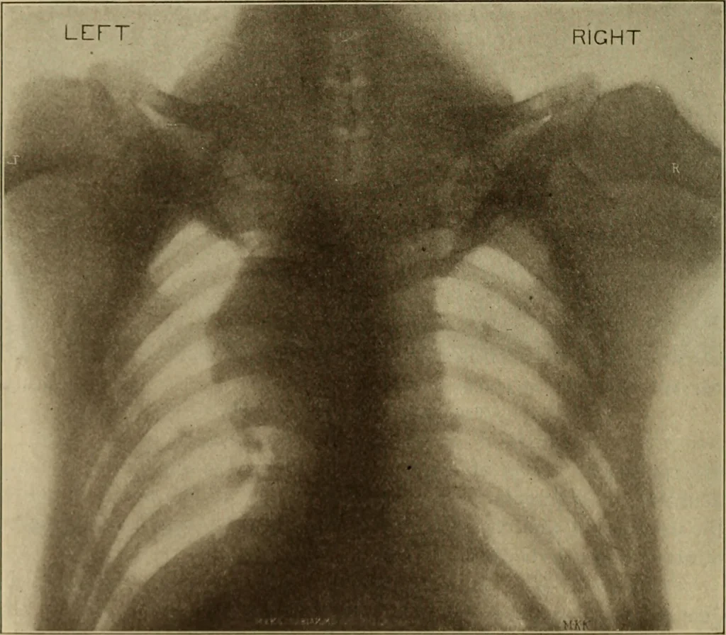 An illustration from The diagnostics of internal medicine : a clinical treatise upon the recognised principles of medical diagnosis, prepared for the use of students and practitioners of medicine / by Glentworth Reeve Butler ... ; with five coloured plates and two hundred and seventy-two illustrations and charts in the text., 1909, leaf 768