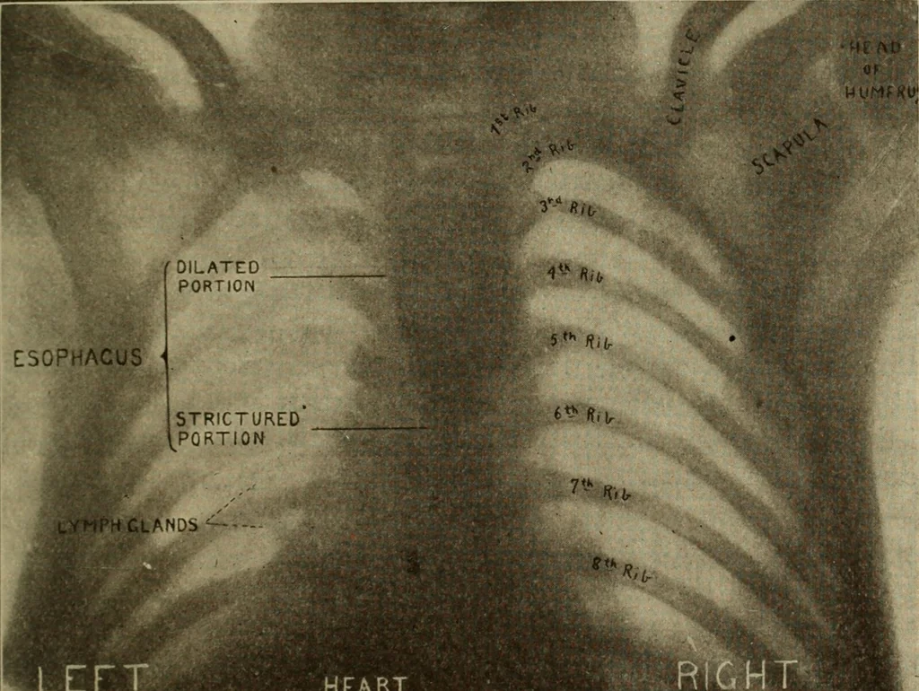 An illustration from The diagnostics of internal medicine : a clinical treatise upon the recognised principles of medical diagnosis, prepared for the use of students and practitioners of medicine / by Glentworth Reeve Butler ... ; with five coloured plates and two hundred and seventy-two illustrations and charts in the text., 1909, leaf 769