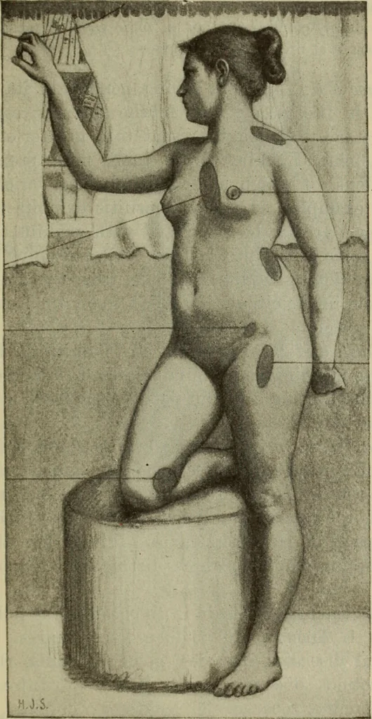 An illustration from The diagnostics of internal medicine : a clinical treatise upon the recognised principles of medical diagnosis, prepared for the use of students and practitioners of medicine / by Glentworth Reeve Butler ... ; with five coloured plates and two hundred and seventy-two illustrations and charts in the text., 1909, leaf 85