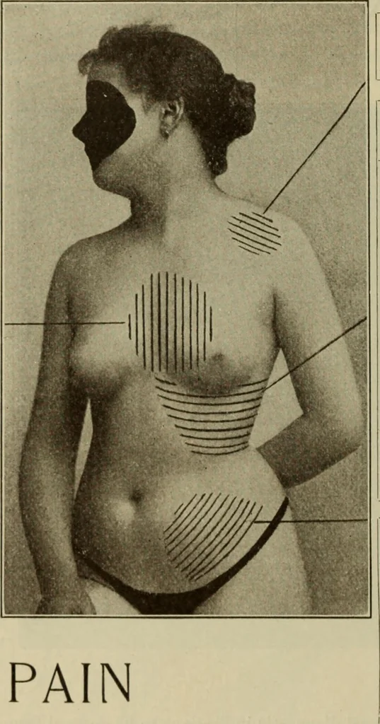 An illustration from The diagnostics of internal medicine : a clinical treatise upon the recognised principles of medical diagnosis, prepared for the use of students and practitioners of medicine / by Glentworth Reeve Butler ... ; with five coloured plates and two hundred and seventy-two illustrations and charts in the text., 1909, leaf 92