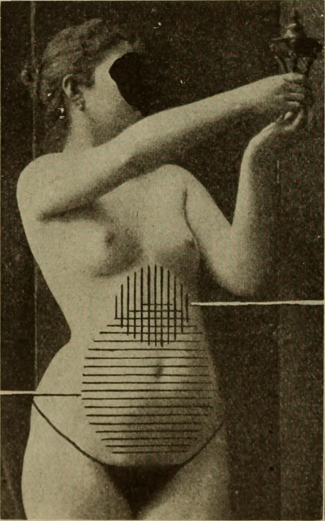 An illustration from The diagnostics of internal medicine : a clinical treatise upon the recognised principles of medical diagnosis, prepared for the use of students and practitioners of medicine / by Glentworth Reeve Butler ... ; with five coloured plates and two hundred and seventy-two illustrations and charts in the text., 1909, leaf 96