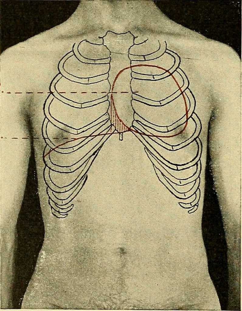 An illustration from Diseases of the heart and arterial system : designed to be a practical presentation of the subject for the use of students and practitioners of medicine / by Robert H. Babcock ; with three coloured plates and one hundred and thirty-nine illustrations., 1907, leaf 108