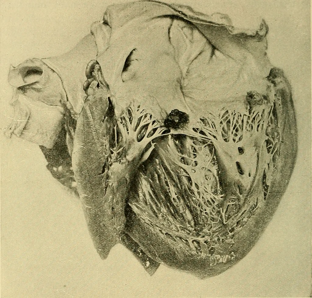 An illustration from Diseases of the heart and arterial system : designed to be a practical presentation of the subject for the use of students and practitioners of medicine / by Robert H. Babcock ; with three coloured plates and one hundred and thirty-nine illustrations., 1907, leaf 176
