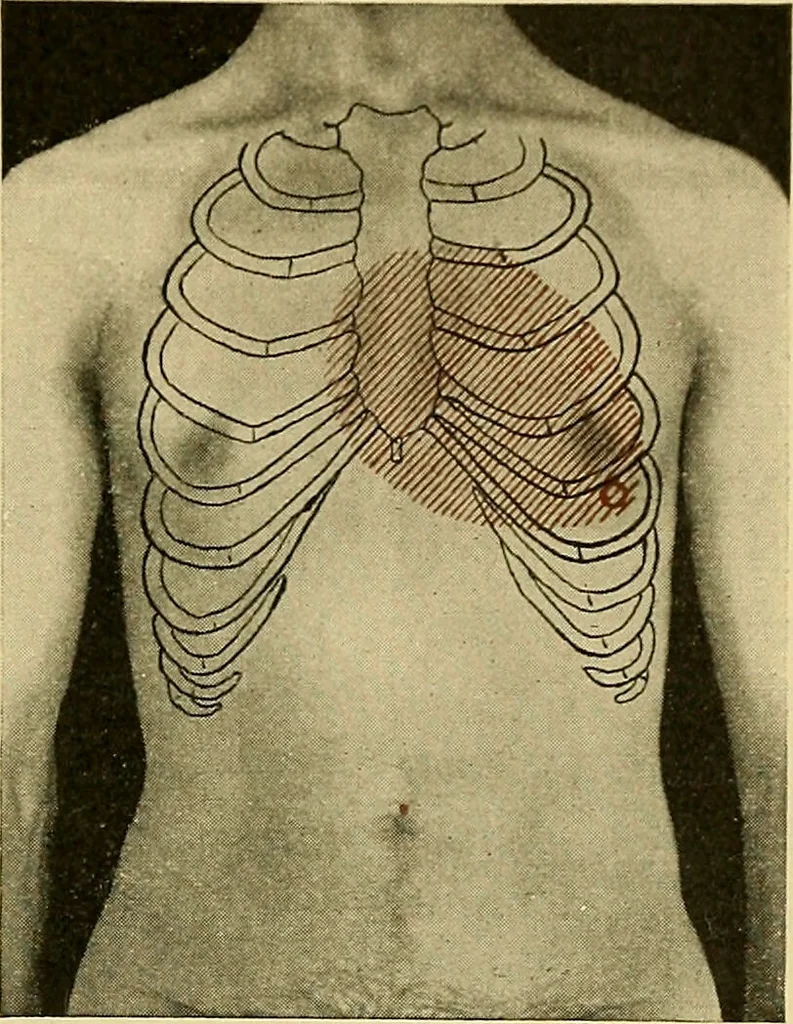 An illustration from Diseases of the heart and arterial system : designed to be a practical presentation of the subject for the use of students and practitioners of medicine / by Robert H. Babcock ; with three coloured plates and one hundred and thirty-nine illustrations., 1907, leaf 189
