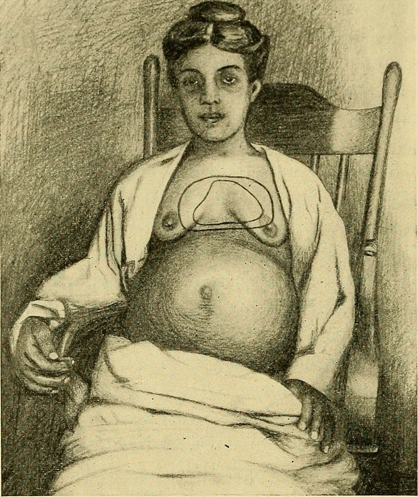 An illustration from Diseases of the heart and arterial system : designed to be a practical presentation of the subject for the use of students and practitioners of medicine / by Robert H. Babcock ; with three coloured plates and one hundred and thirty-nine illustrations., 1907, leaf 288