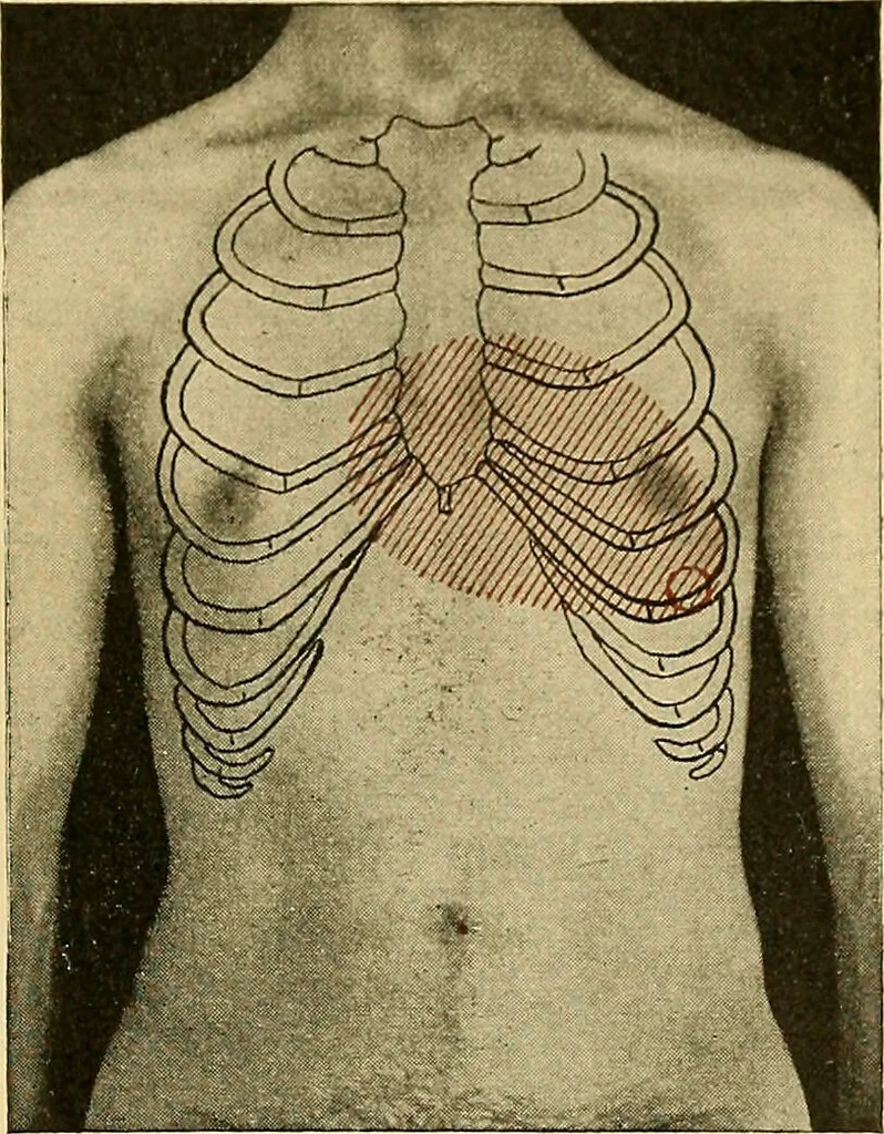 An illustration from Diseases of the heart and arterial system : designed to be a practical presentation of the subject for the use of students and practitioners of medicine / by Robert H. Babcock ; with three coloured plates and one hundred and thirty-nine illustrations., 1907, leaf 301