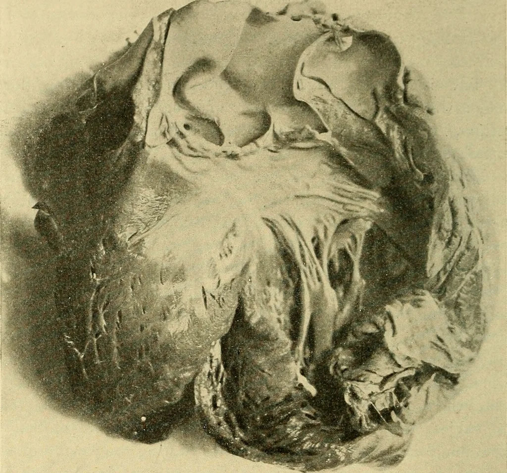 An illustration from Diseases of the heart and arterial system : designed to be a practical presentation of the subject for the use of students and practitioners of medicine / by Robert H. Babcock ; with three coloured plates and one hundred and thirty-nine illustrations., 1907, leaf 352