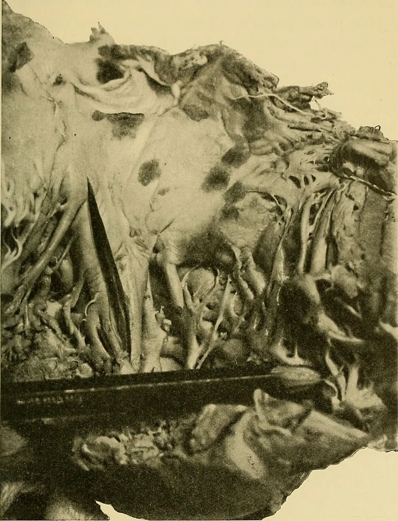 An illustration from Diseases of the heart and arterial system : designed to be a practical presentation of the subject for the use of students and practitioners of medicine / by Robert H. Babcock ; with three coloured plates and one hundred and thirty-nine illustrations., 1907, leaf 61