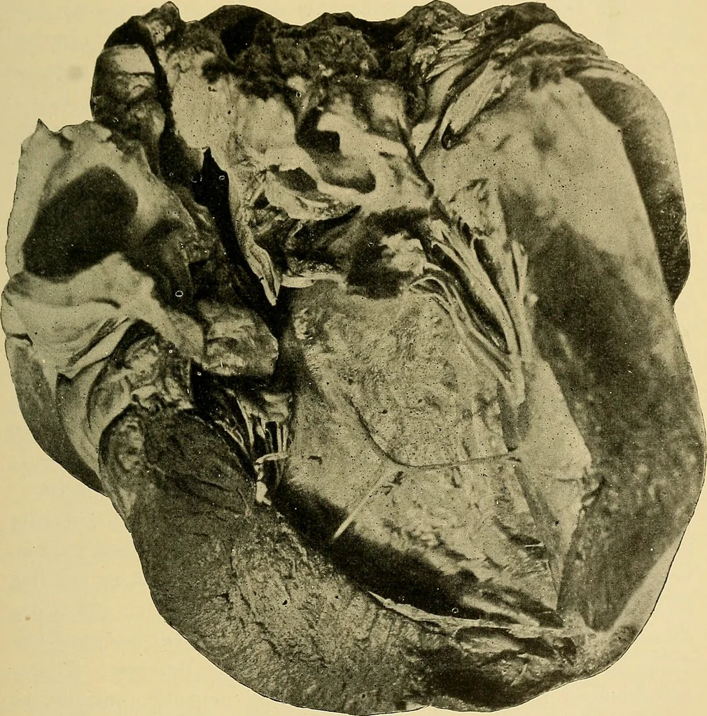 An illustration from Diseases of the heart and arterial system : designed to be a practical presentation of the subject for the use of students and practitioners of medicine / by Robert H. Babcock ; with three coloured plates and one hundred and thirty-nine illustrations., 1907, leaf 63