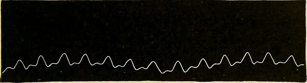 An illustration from Diseases of the heart and arterial system : designed to be a practical presentation of the subject for the use of students and practitioners of medicine / by Robert H. Babcock ; with three coloured plates and one hundred and thirty-nine illustrations., 1907, leaf 767