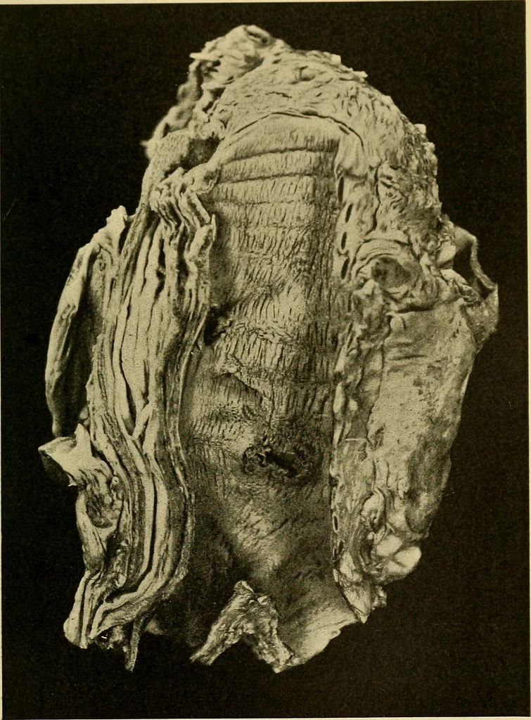 An illustration from Diseases of the heart and arterial system : designed to be a practical presentation of the subject for the use of students and practitioners of medicine / by Robert H. Babcock ; with three coloured plates and one hundred and thirty-nine illustrations., 1907, leaf 831