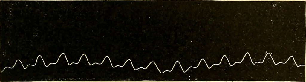 An illustration from Diseases of the heart and arterial system : designed to be a practical presentation of the subject for the use of students and practitioners of medicine / by Robert H. Babcock ; with three coloured plates and one hundred and thirty-nine illustrations., 1907, leaf 853