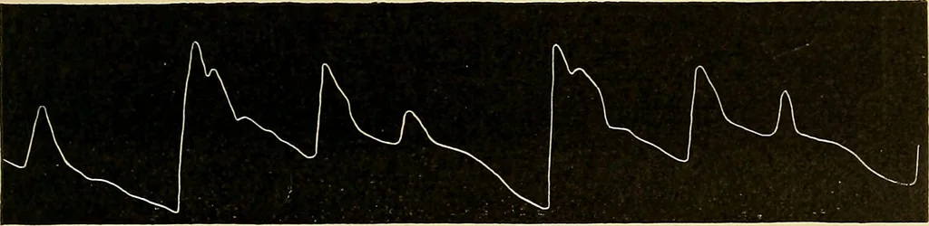 An illustration from Diseases of the heart and arterial system : designed to be a practical presentation of the subject for the use of students and practitioners of medicine / by Robert H. Babcock ; with three coloured plates and one hundred and thirty-nine illustrations., 1907, leaf 857