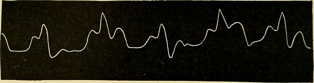 An illustration from Diseases of the heart and arterial system : designed to be a practical presentation of the subject for the use of students and practitioners of medicine / by Robert H. Babcock ; with three coloured plates and one hundred and thirty-nine illustrations., 1907, leaf 860