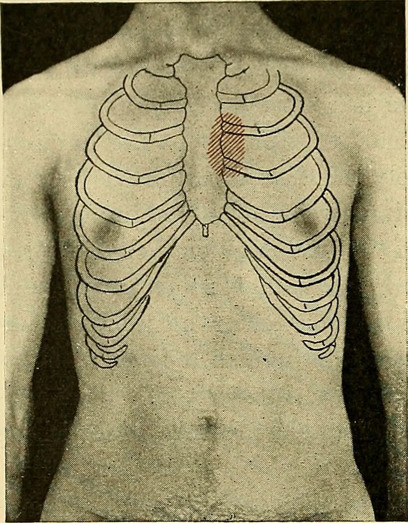 An illustration from Diseases of the heart and arterial system : designed to be a practical presentation of the subject for the use of students and practitioners of medicine / by Robert H. Babcock ; with three coloured plates and one hundred and thirty-nine illustrations., 1907, leaf 88