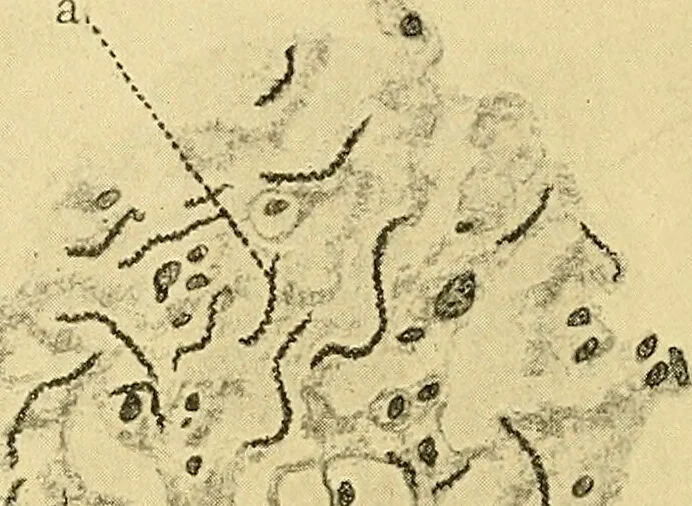 An illustration from A text-book of pathology for students of medicine / by J. George Adami and John McCrae ; illustrated with 304 engravings and 11 colored plates., 1912, leaf 100
