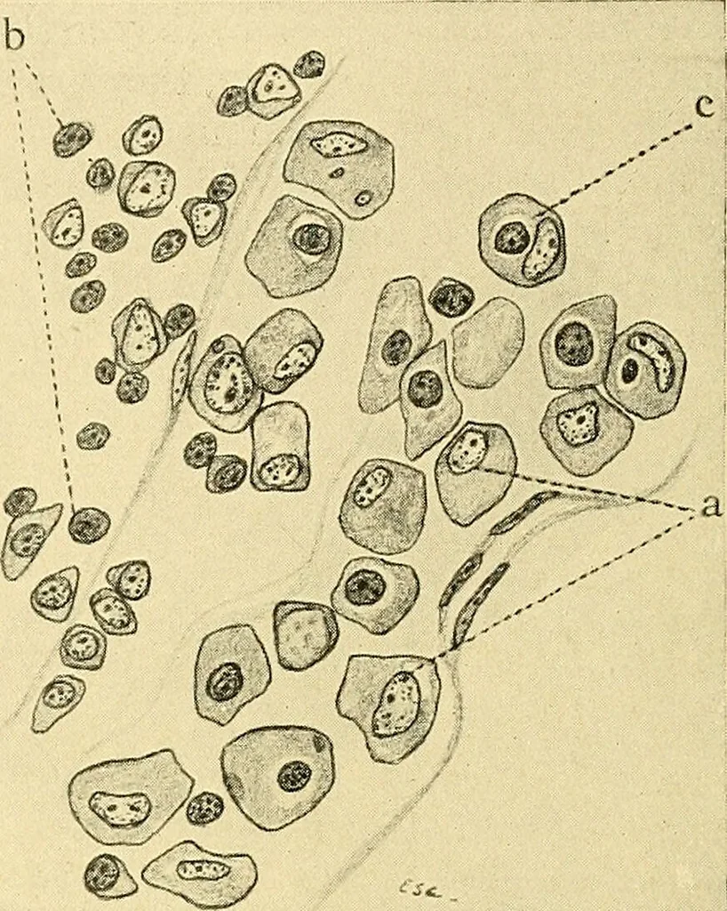 An illustration from A text-book of pathology for students of medicine / by J. George Adami and John McCrae ; illustrated with 304 engravings and 11 colored plates., 1912, leaf 138